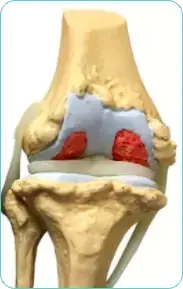 Settimana 1 – Primo sollievo dal dolore articolare
