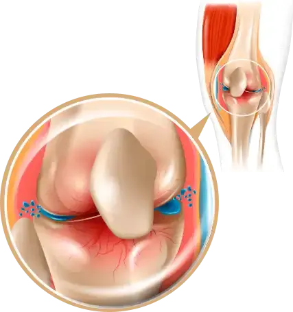 Degenerazione articolare – come si sviluppa il dolore